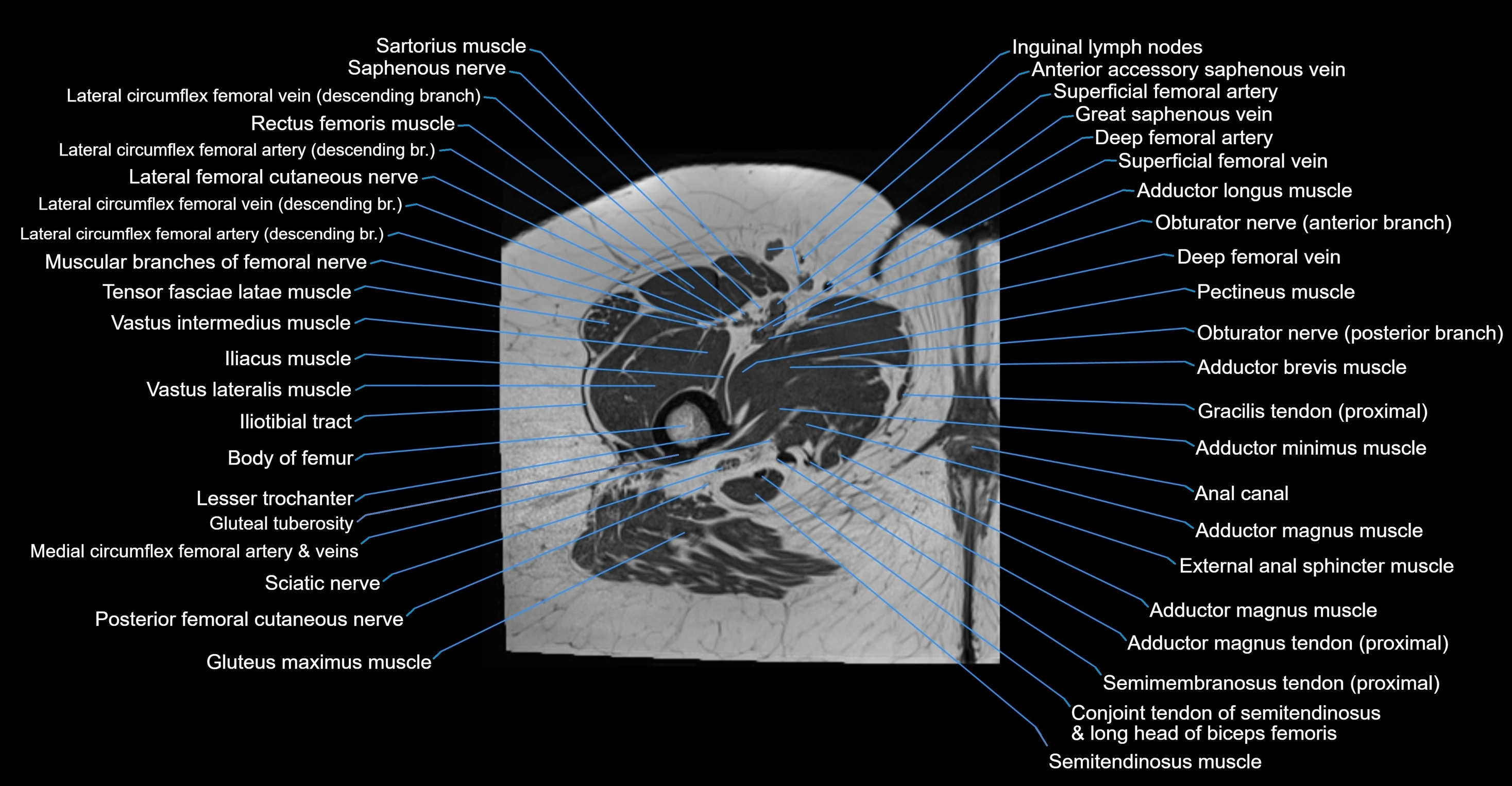 MRI hip axial cross sectional anatomy 3T 3D  radiology  anatomy image-img-00001-00077.webp